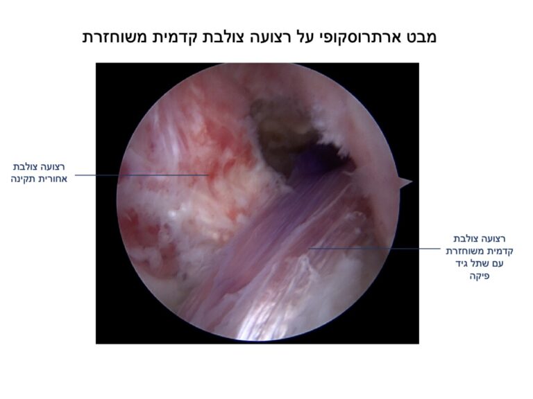 שחזור רצועה צולבת קדמית ACL RECONSTRUCTION