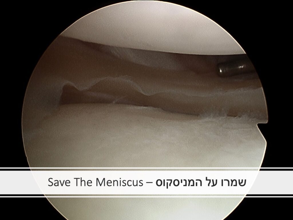 מניסקוס
