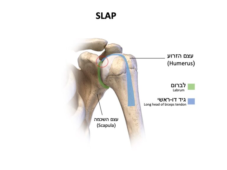 פגיעה בקומפלס לברום/גיד דו ראשי בכתף SLAP
