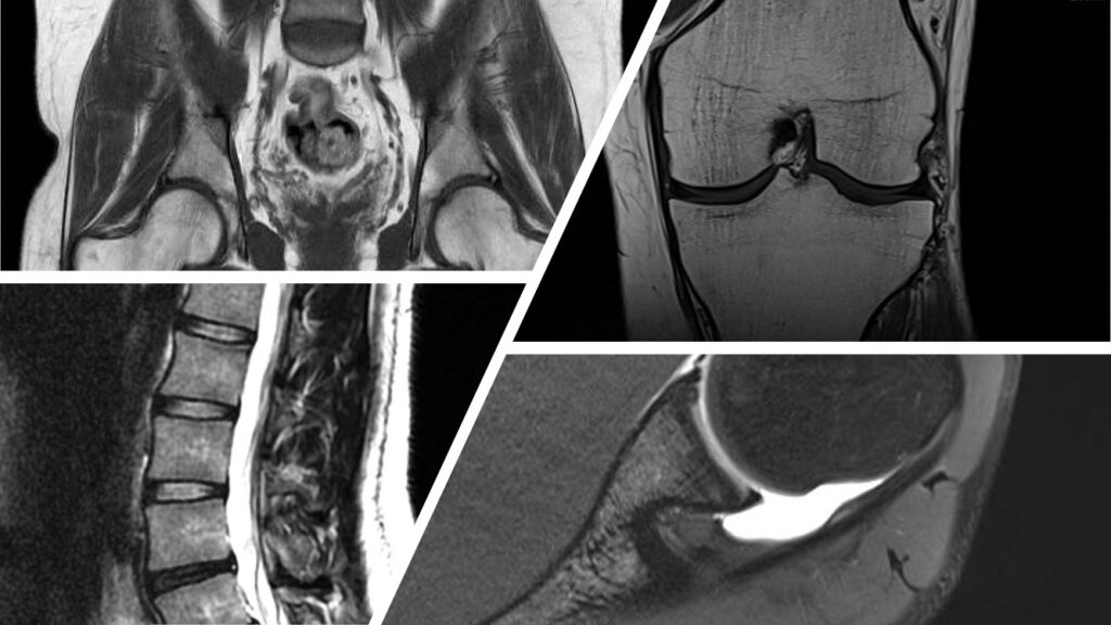 MRI