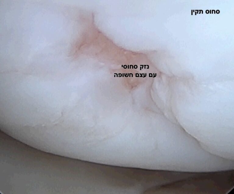 cartilage