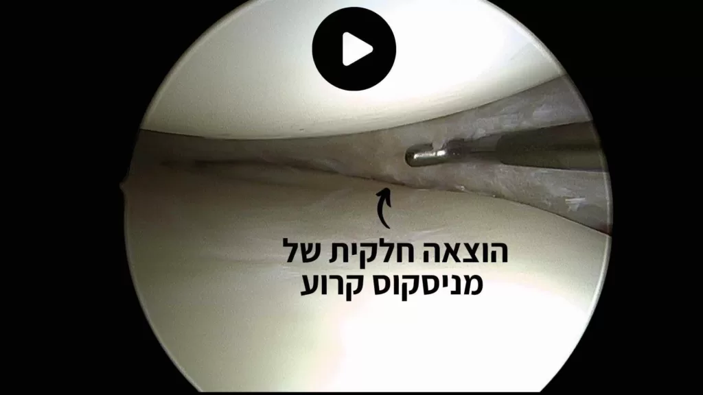 הוצאה חלקית של מניסקוס קרוע