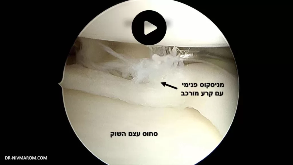 קרע במניסקוס