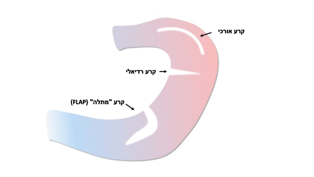 meniscal tears