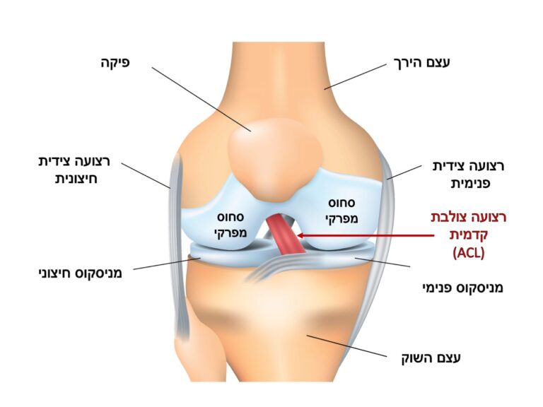 ACL tear