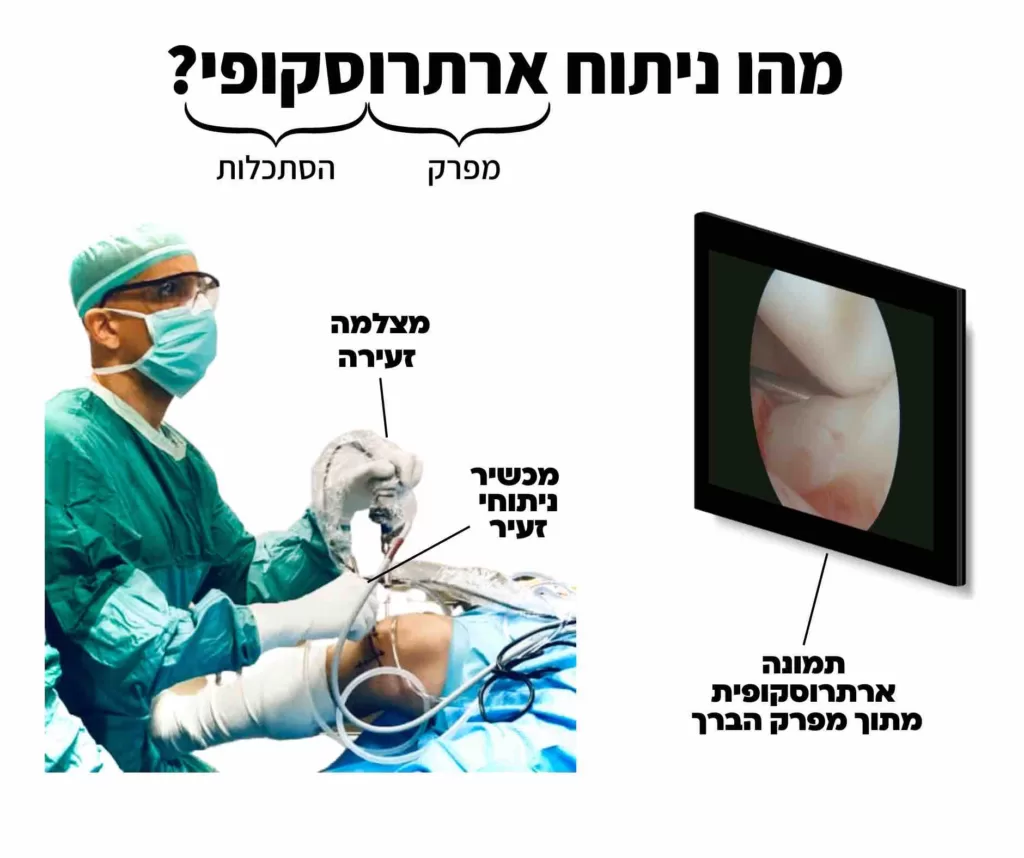 ניתוח ארתרוסקופי