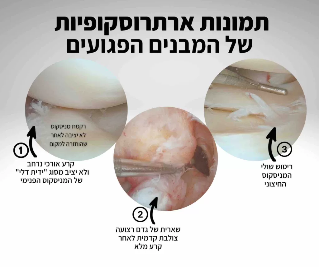 קרע רצועה צולבת קדמית קרע ידית דלי קרע מניסקוס