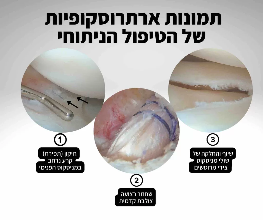 ניתוח לשחזור רצועה צולבת קדמית ותיקון מניסקוס