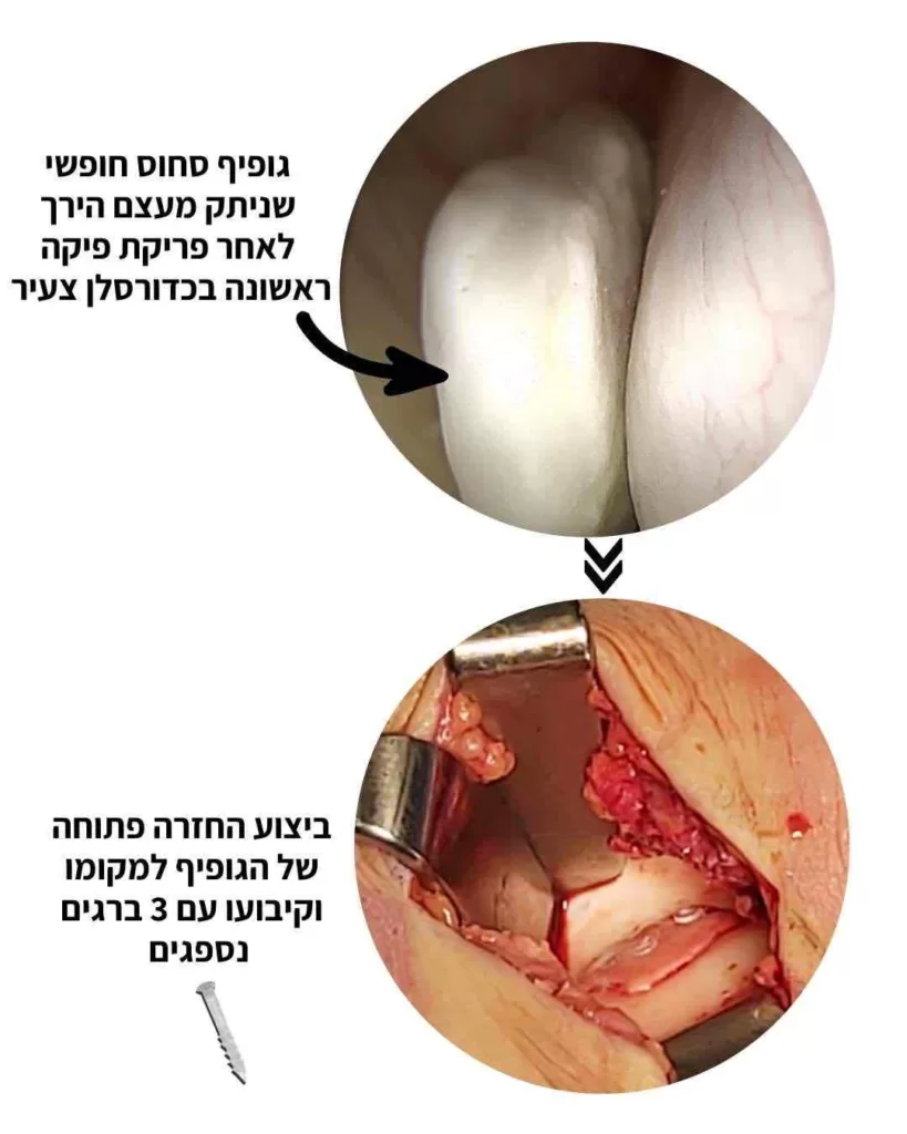 גוף סחוסי חופשי בברך שעבר קיבוע
